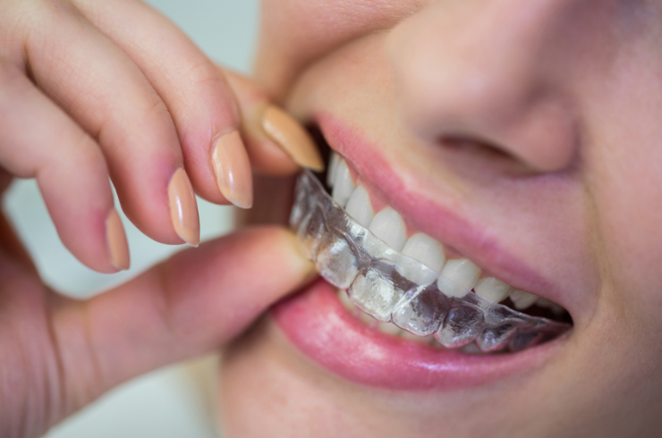 Teeth Alignment