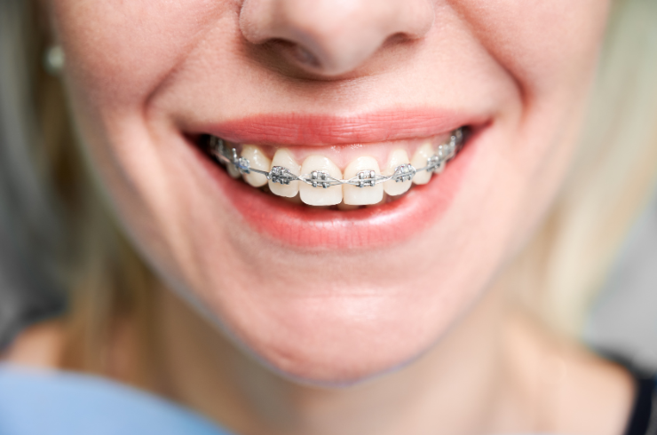 Orthodontic Braces